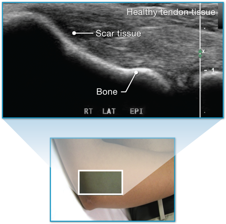 Tenex Health TX Procedure for Tendonitis - Ainsworth Institute