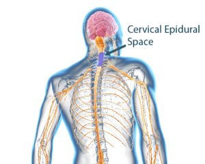 CESI - Cervical Epidural Injection, neck pain, neck pain treatments, neck pain treatments NYC