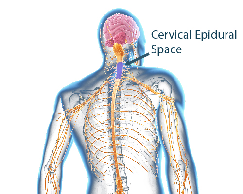 CESI, Cervical epidural steroid injection, neck pain, pain treatments, neck pain treatments, pain doctor neck pain
