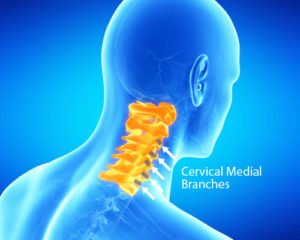 Cervical Medial Branch Block - Ainsworth Institute