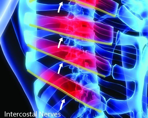 Intercostal Nerve Block New York NYC New York City Post thoracotomy syndrome post mastectomy syndrome