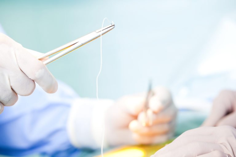 Endoscopic Discectomy and Microdiscectomy Ainsworth Institute