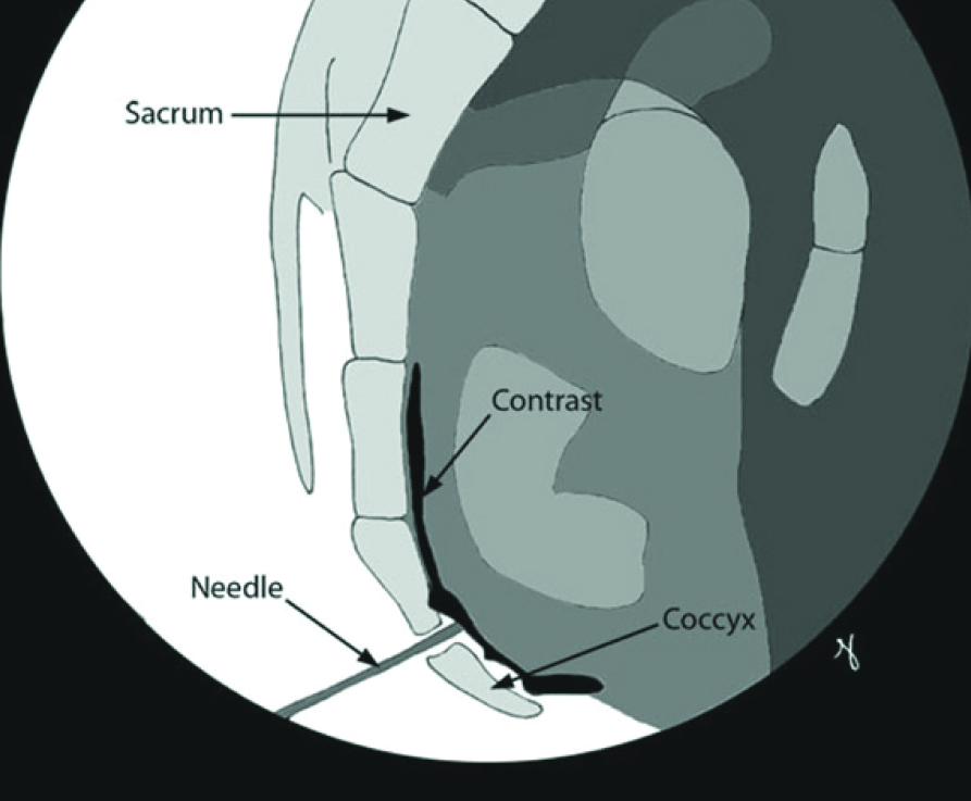 coccyx injection