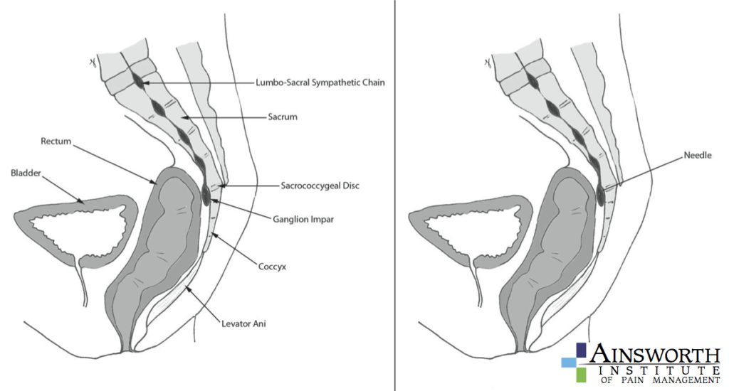 Ganglion of Impar Block Ainsworth Institute