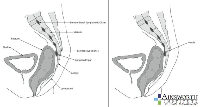 Ganglion Of Impar Block Ainsworth Institute