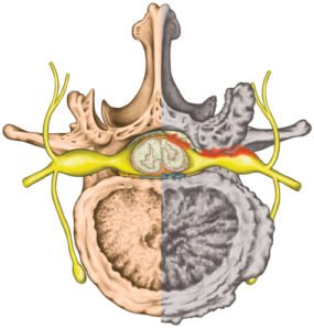 Spinal Stenosis - Ainsworth Institute