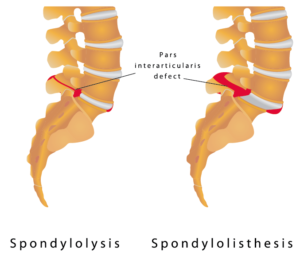 Spondylolisthesis - Ainsworth Institute