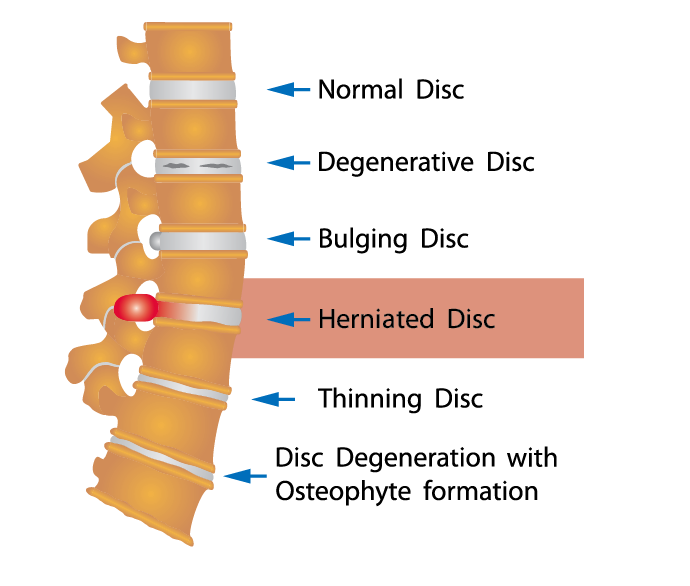 What is mistaken for a herniated disc?