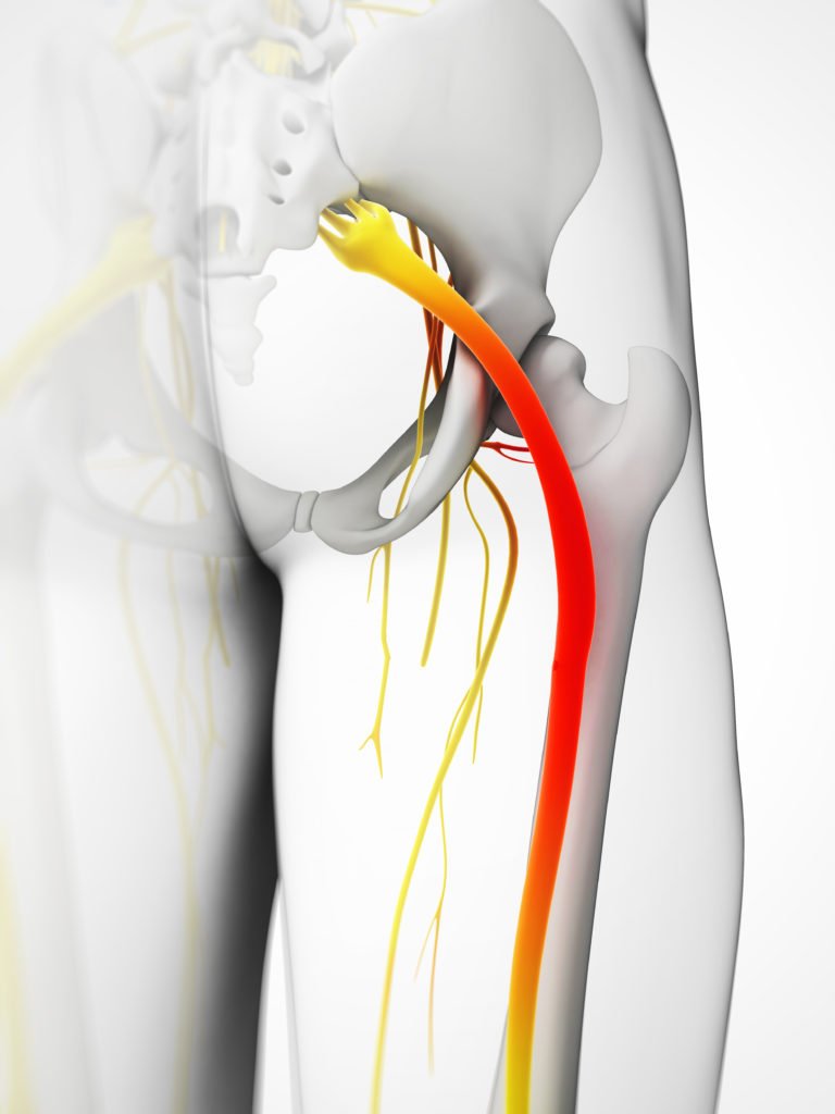What is Sciatica and the Cause of Sciatic Nerve Pain?
