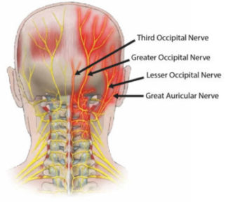 occipital nerve, occipital neuralgia, headachesm mnigraines, botox