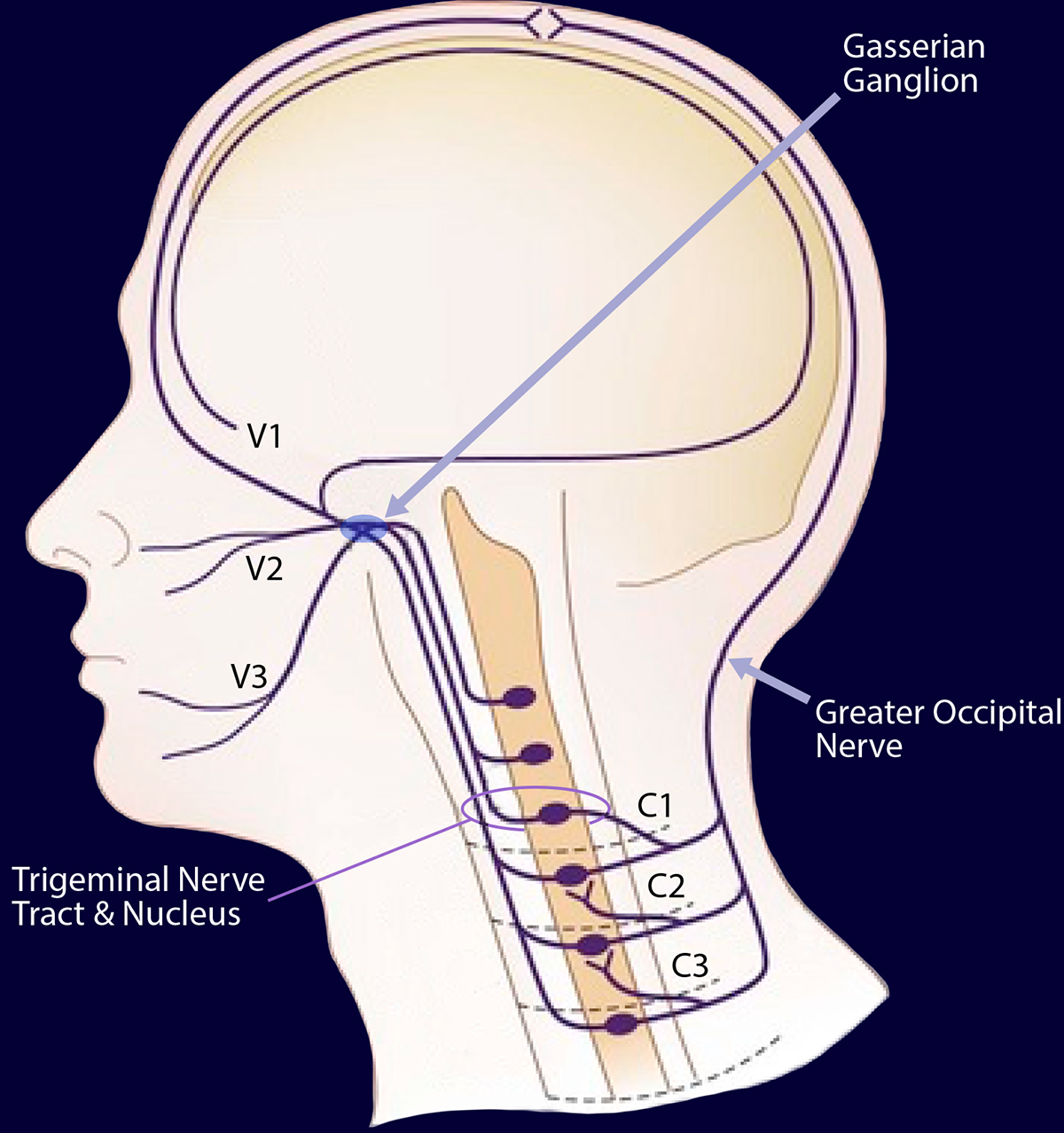 Headache Migraine Ainsworth Institute