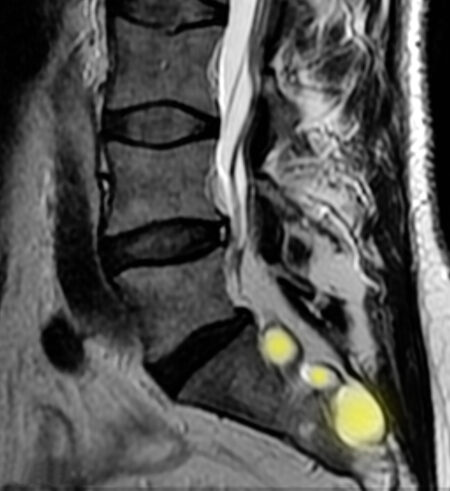 Tarlov Cyst - Ainsworth Institute